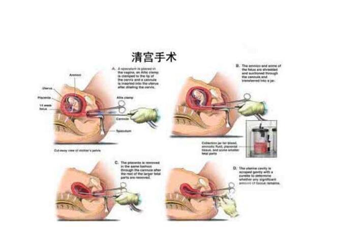 最新人流技术，探索前沿科技在人工流产领域的应用实践